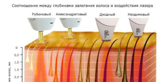 Что такое лазерная эпиляция и как она работает